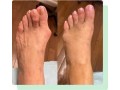 warts-on-feet-treatment-perth-amboy-nj-small-0