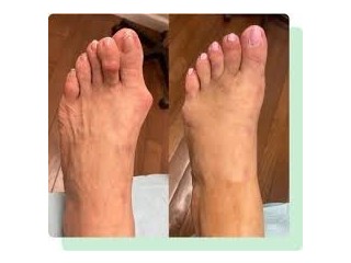 Warts On Feet Treatment Perth Amboy, NJ