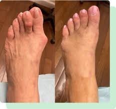 warts-on-feet-treatment-perth-amboy-nj-big-0