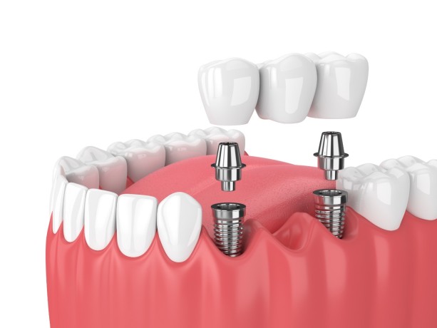 implant-dentist-near-me-big-0